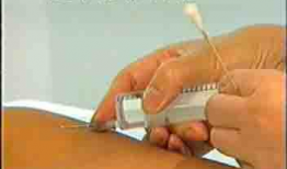 皮下针注射方法视频,视频教程详解